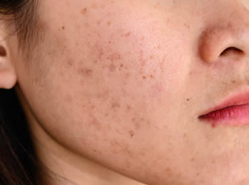 Địa chỉ điều trị tàn nhang, đốm nâu ở đâu uy tín, chất lượng tại Hải Dương