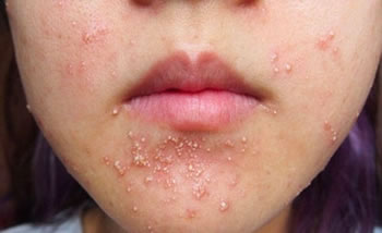 Điều trị mụn đầu trắng cực kỳ hiệu quả